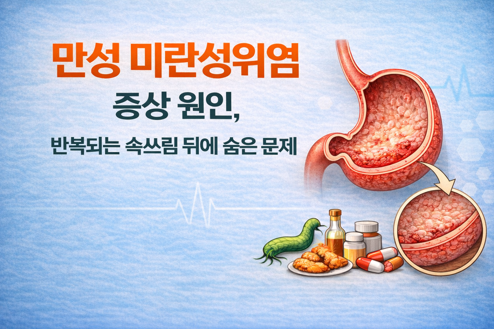 만성 미란성 위염 증상과 원인, 반복되는 속쓰림 뒤에 숨은 문제