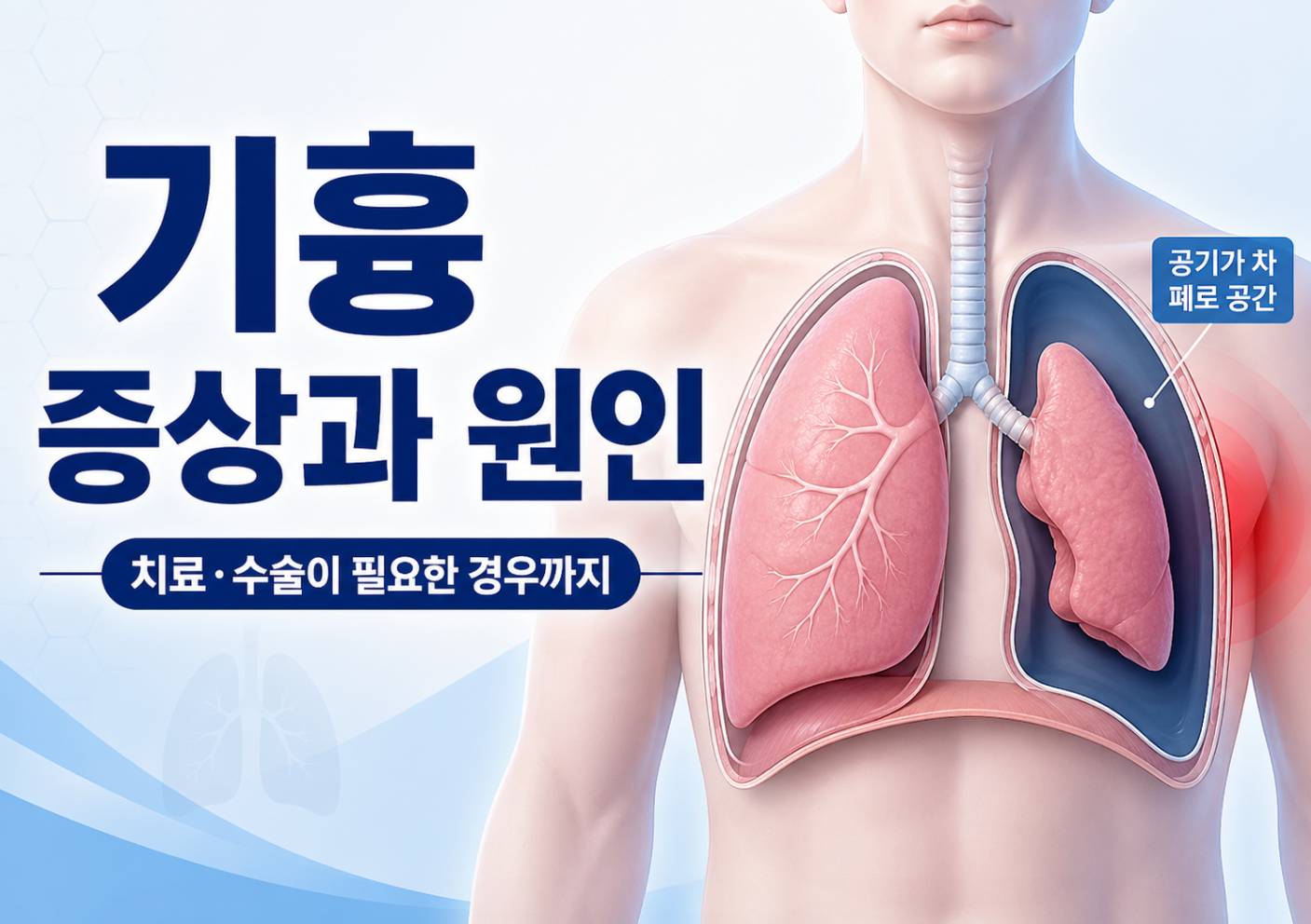 기흉 증상과 원인, 치료·수술이 필요한 경우까지 정리