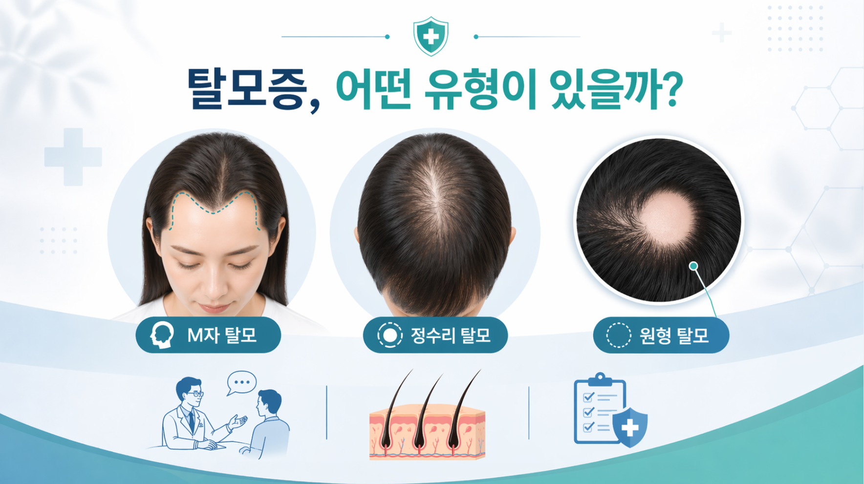 탈모증, 어떤 유형이 있을까?